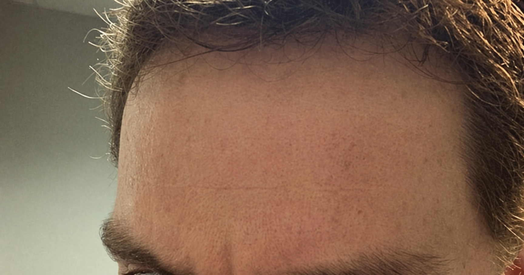 Customer final result photo after topical treatment