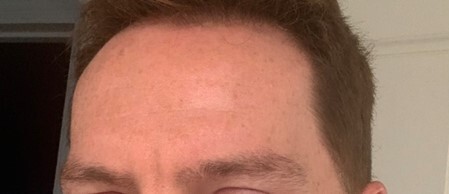 Customer scar photo from July 2022