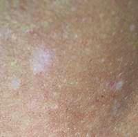 Close-up before treatment photo